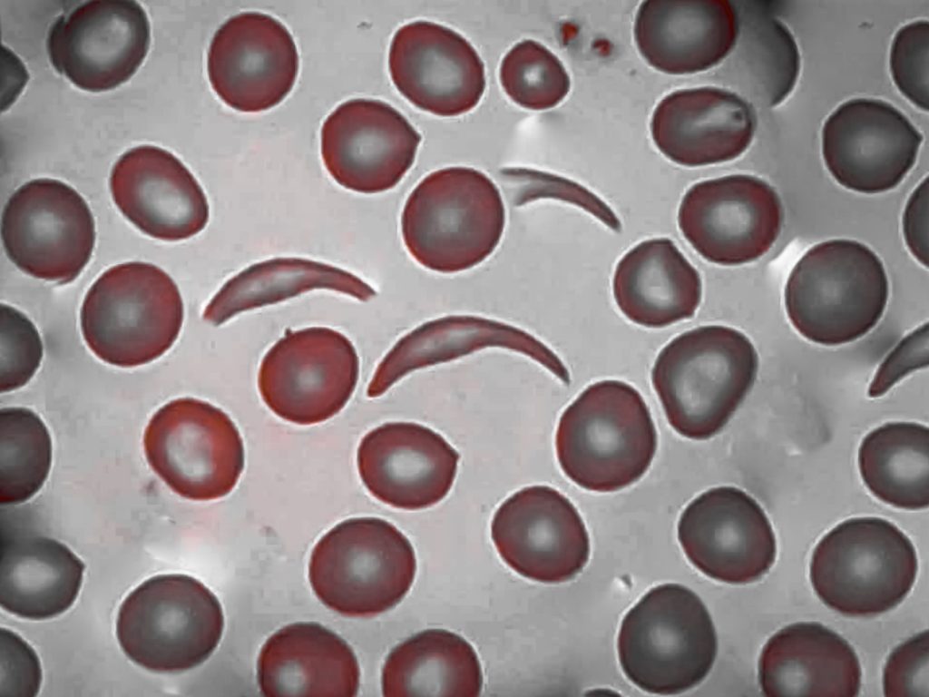 Cellular-level view of sickle cells