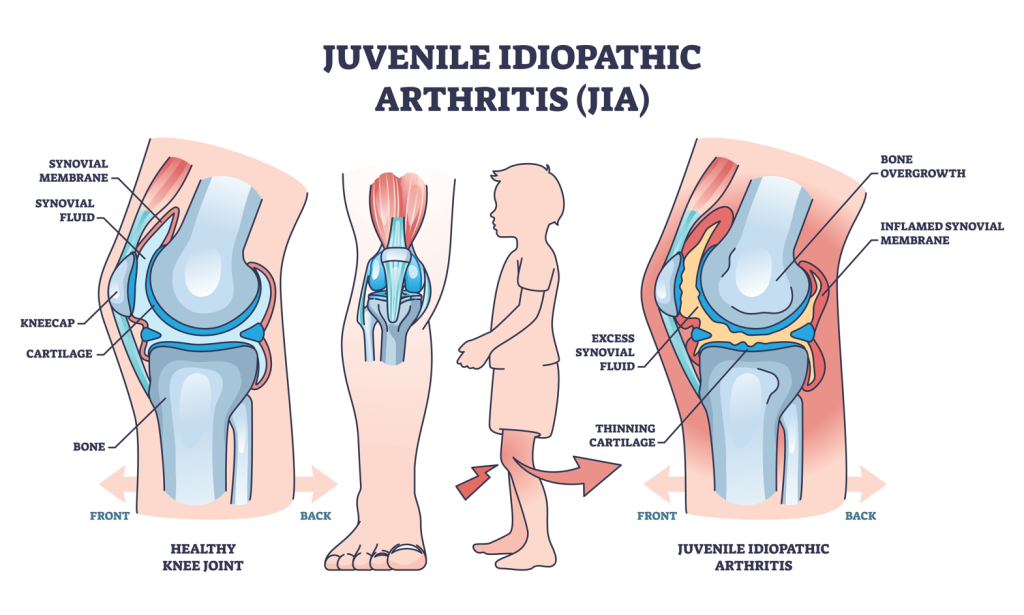 An illustration showing the difference between a healthy knee joint and the knee joint of a child with JIA