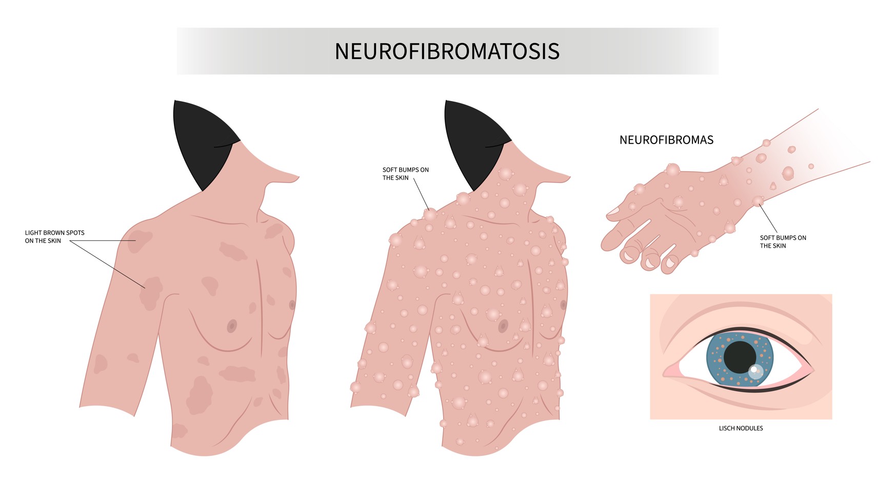 An illustration of NF1 symptoms