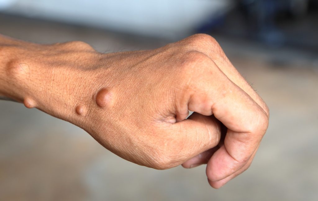 NF1 on adult hand